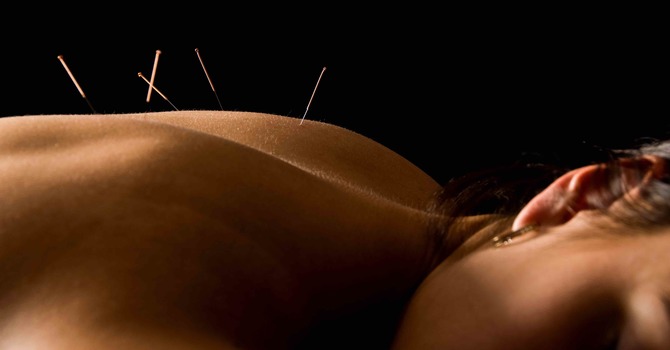 What is acupuncture? image
