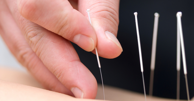 Does Acupuncture Hurt? image